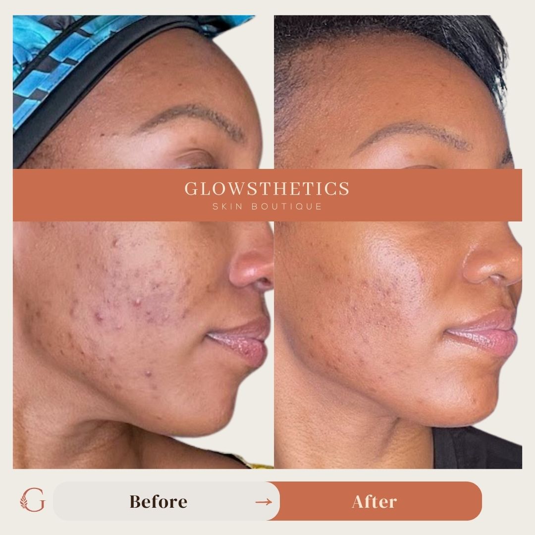 Acne (3)