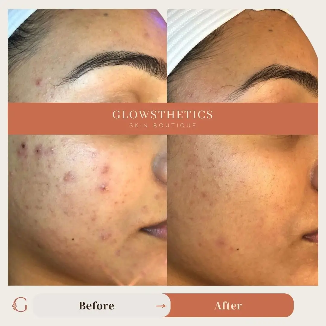 Acne + BioRePeel Page