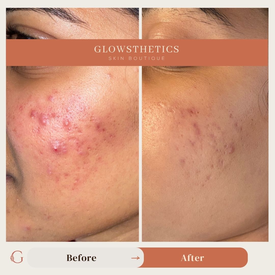 Acne + BioRePeel
