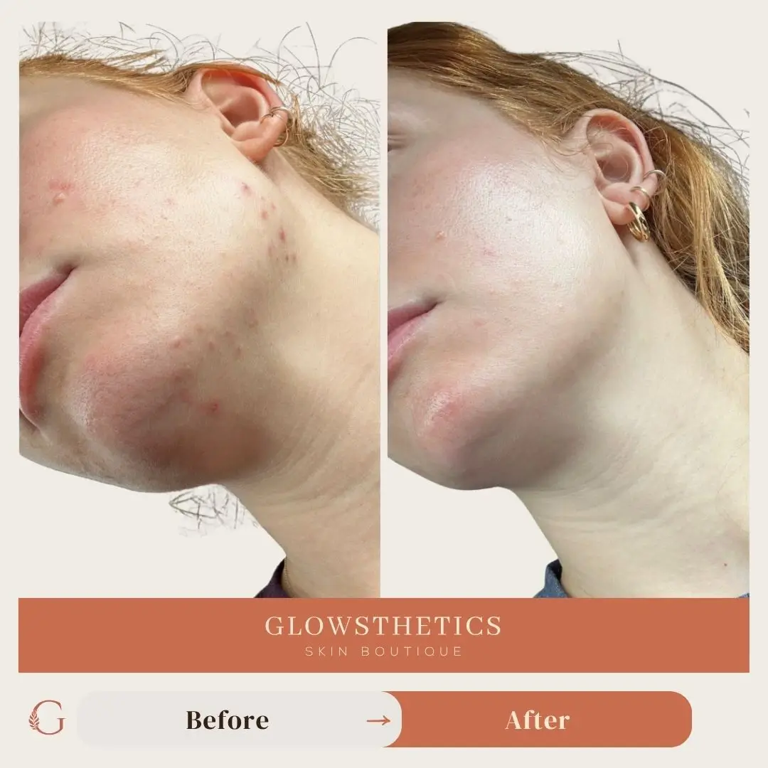 Acne + HF + Micro