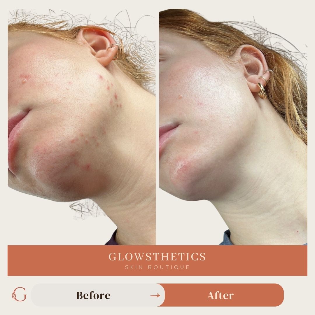 Acne + HF + Micro