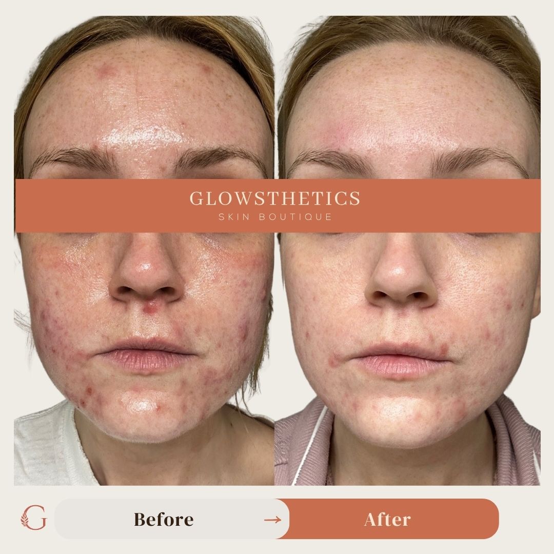 Acne + HF