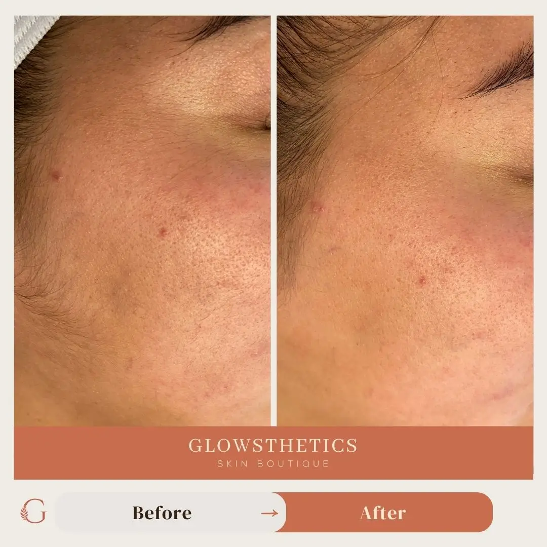 Facial + Dermaplane