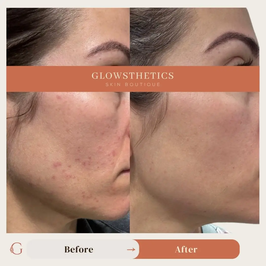 Facial + HF + Acne