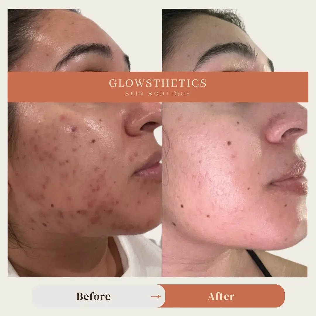 HF + Acne + Micro