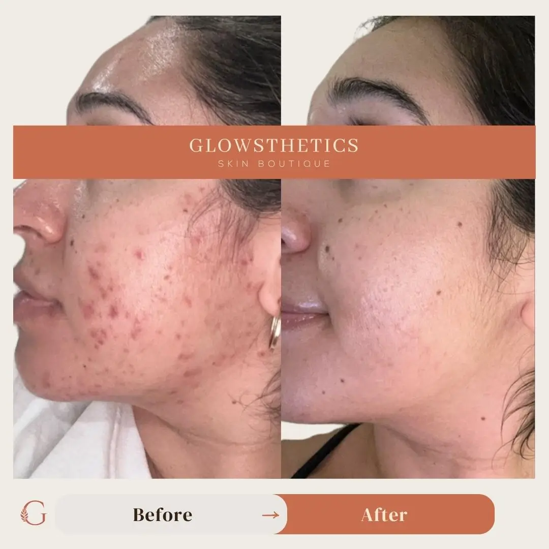HF+ Acne + Micro