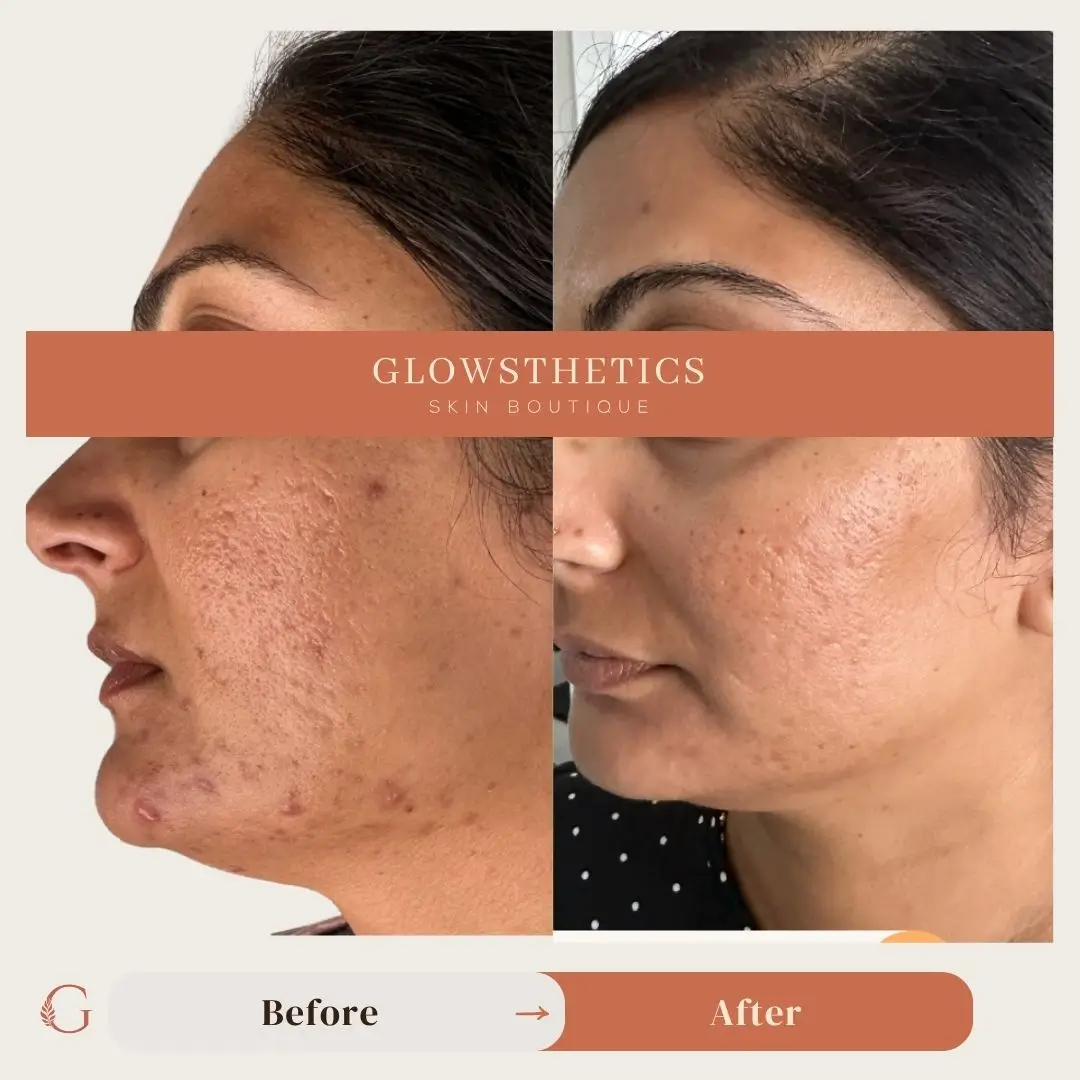 biorepeel+Acne + Micro