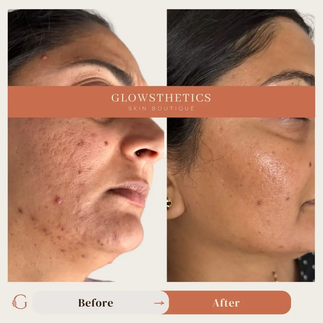 micro + biorepeel + Acne + Micro