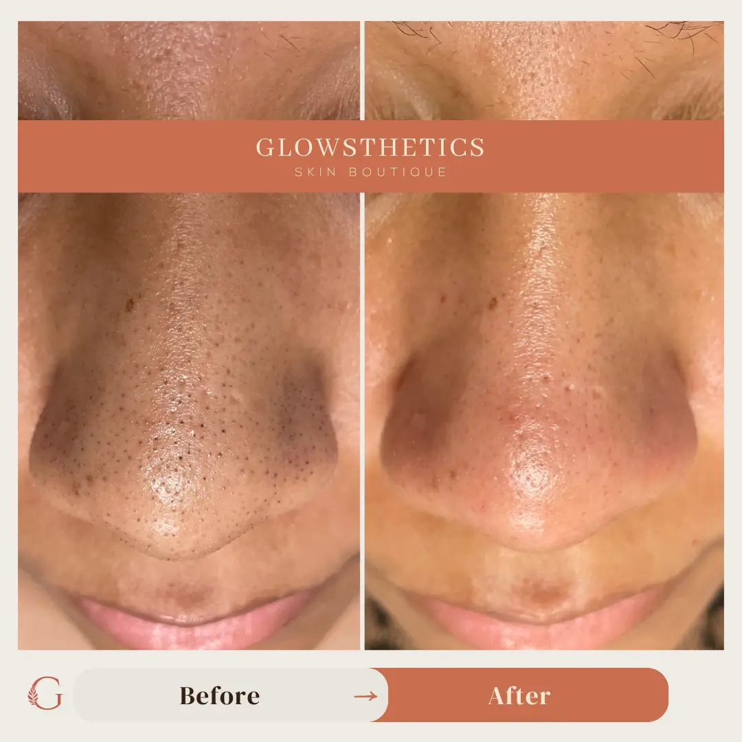 Facial + HF