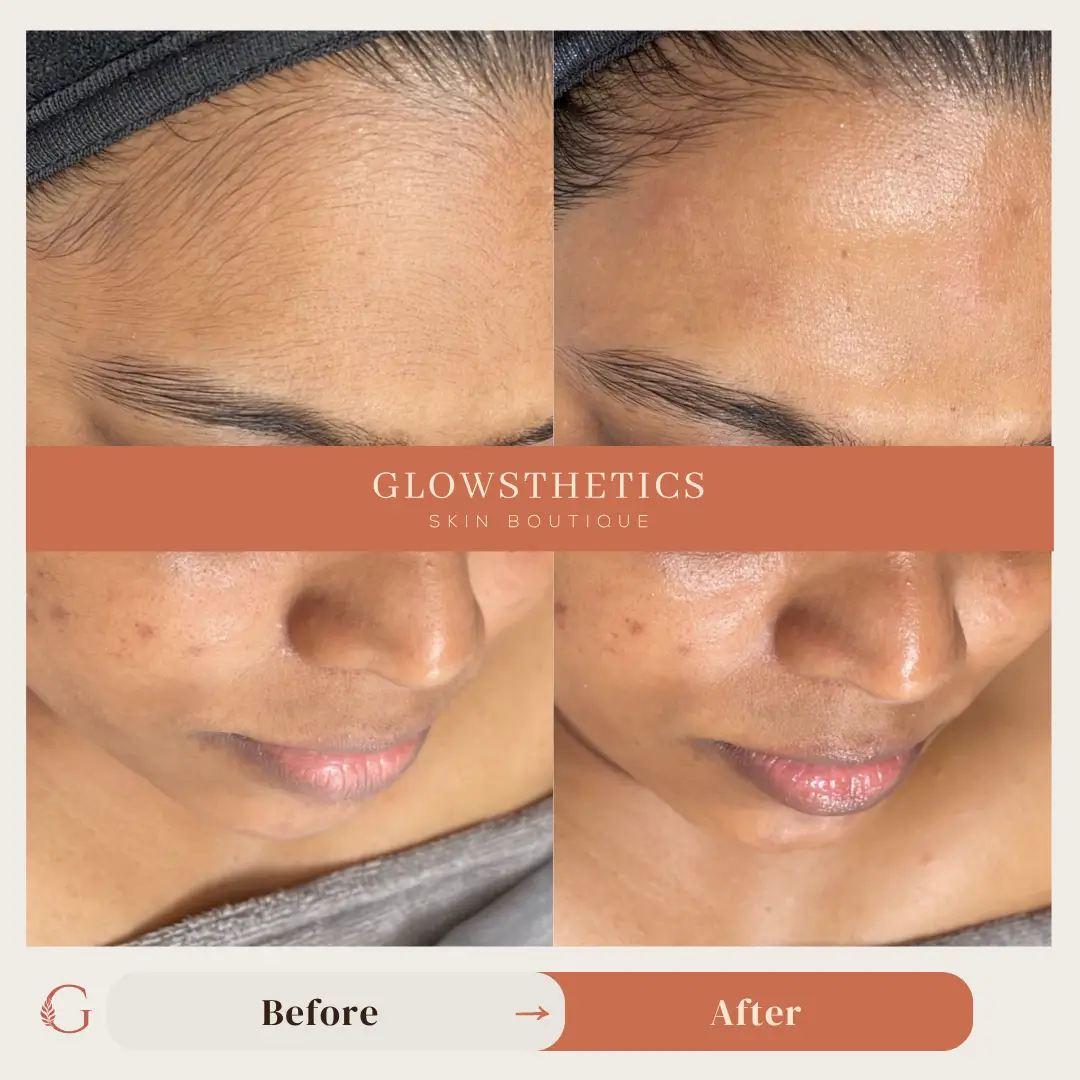 dermaplane